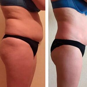 pohudenie_do_i_posle01