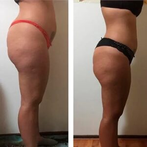 pohudenie_do_i_posle02